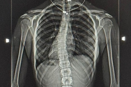 X-ray of Mikaela's scoliosis